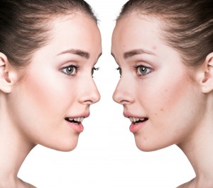 BBL Acne Reduction Training