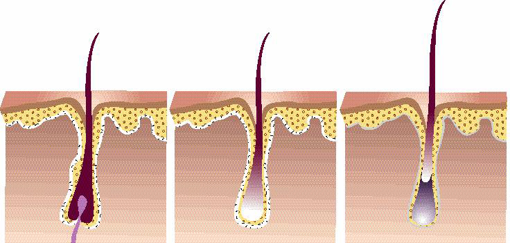 Рост волоса происходит за счет клеток. Телоген фаза роста волос. Цикл волосяного фолликула. Лазерная эпиляция фаза анаген телоген. Стадии роста волос.
