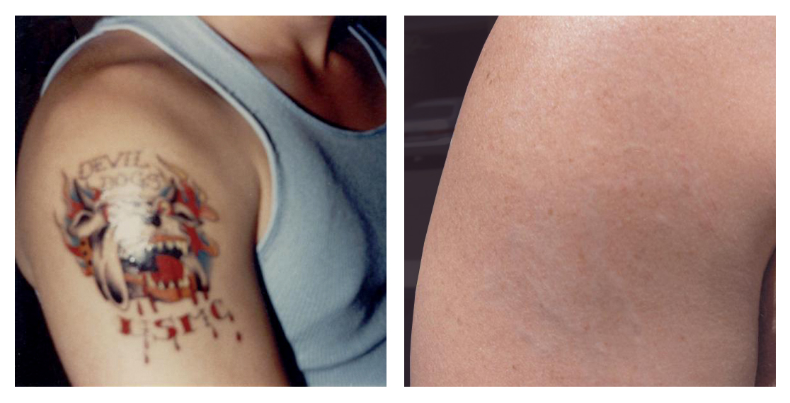 Laser Tattoo Removal