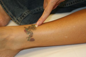 laser tattoo removal training