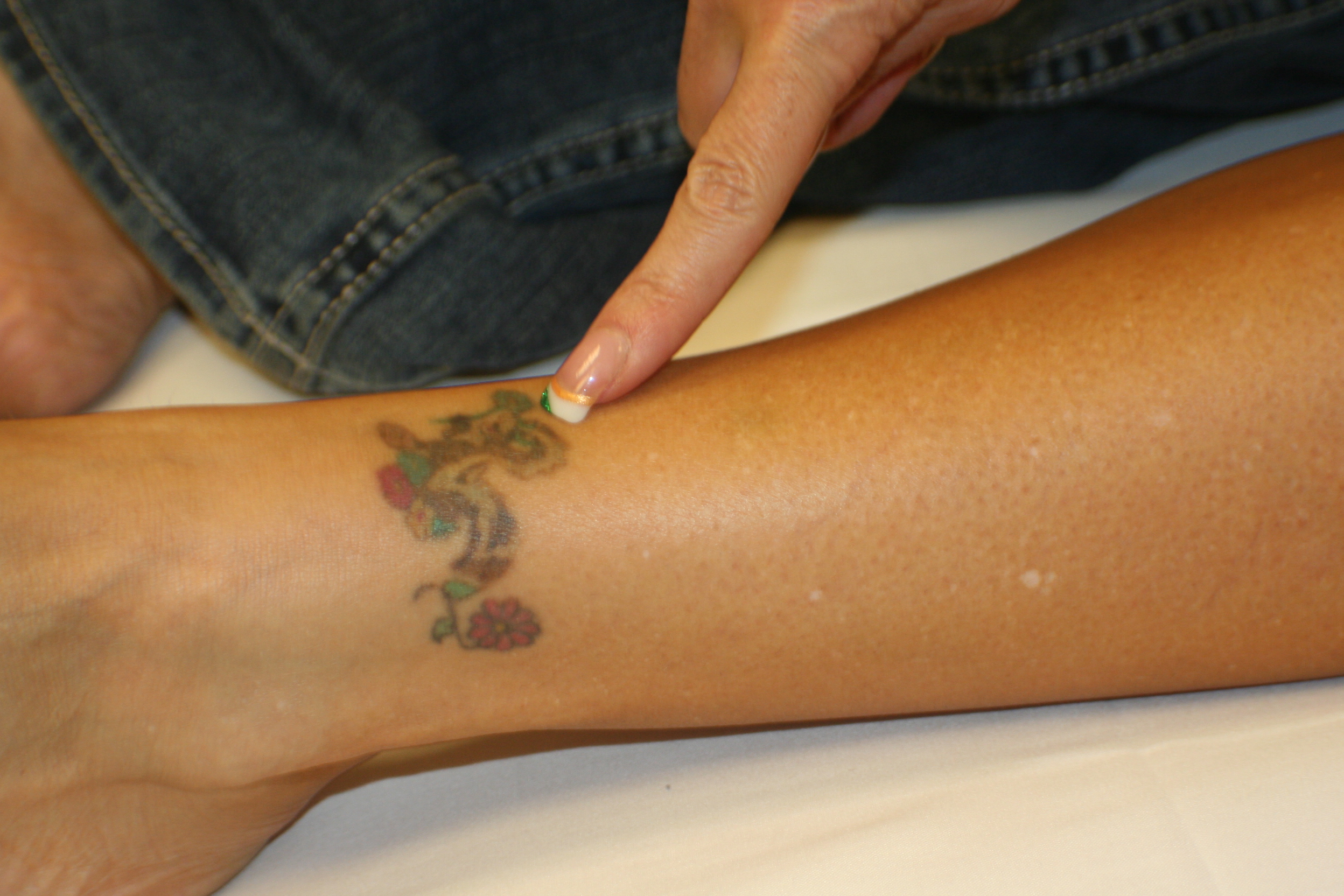 Tattoo Removal & Corrections in The Woodlands, Texas • Brow Design  International