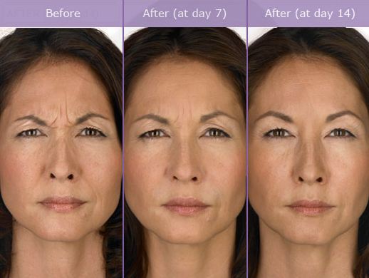 Taping Your Face to Prevent Wrinkles as Good as Botox Injections?