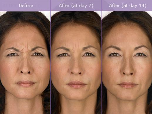 https://nationallaserinstitute.com/wp-content/uploads/2013/05/Botox.jpg