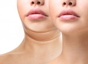 Facts About Kybella