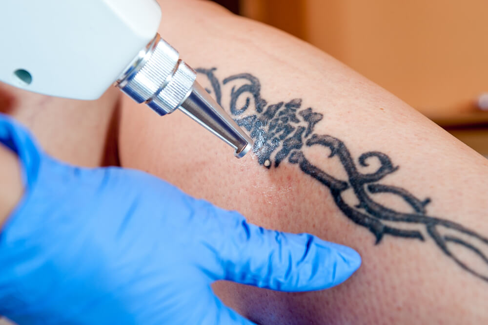 Can Lasers Full Remove Color Tattoos? - Westlake Dermatology