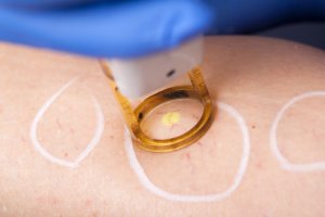 Learn How To Treat Spider Veins During Laser Training