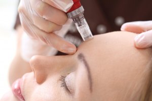 The Benefits of Microneedling