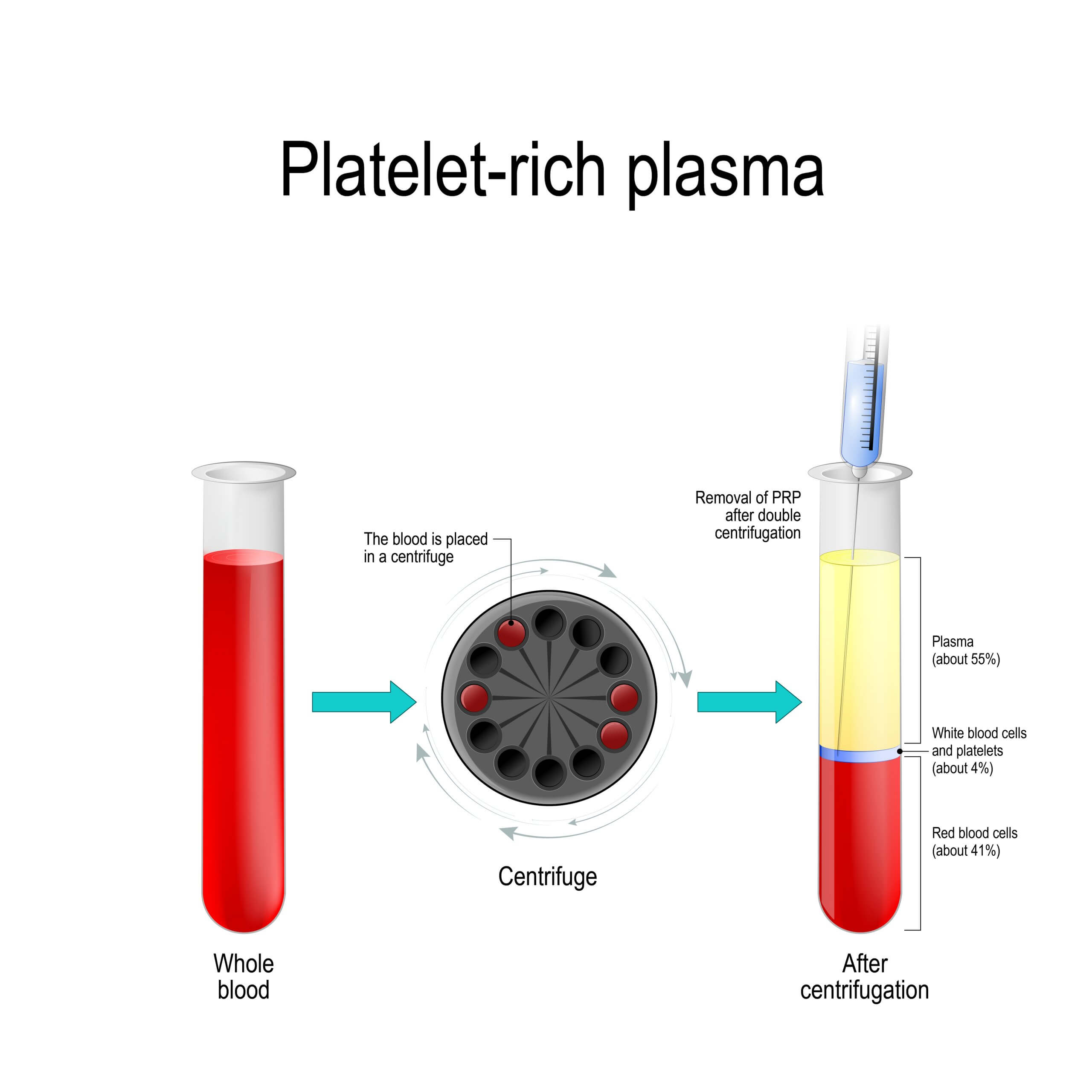 PRF Injections require centrifuges to spin the blood down