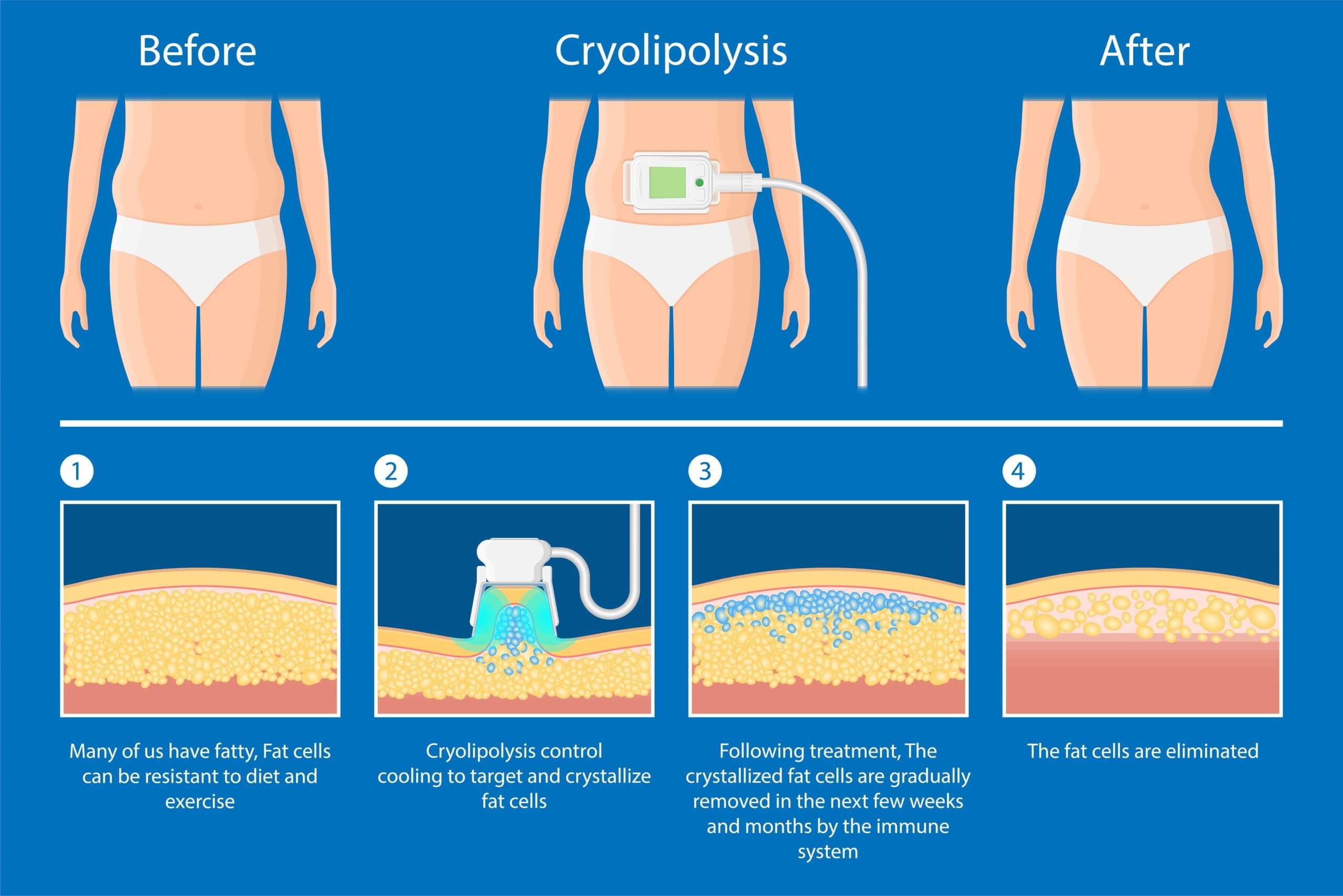 coolsculpting body contouring training graph showing how the coolsculpting process works