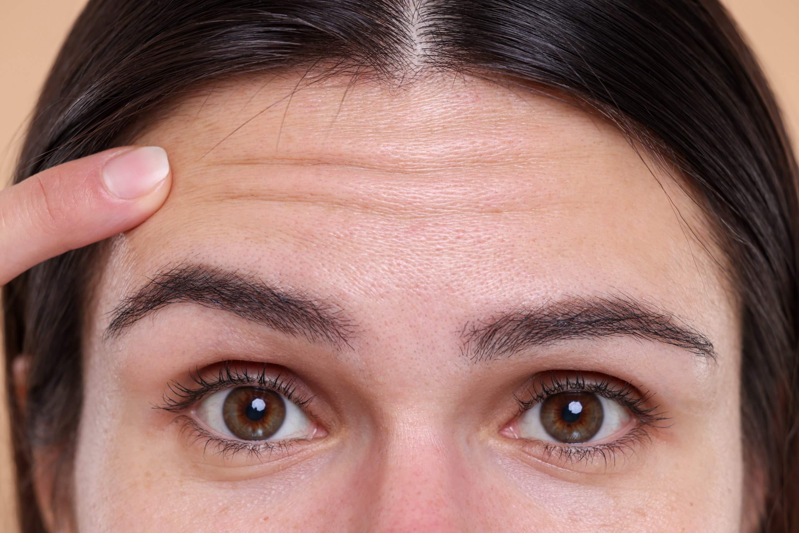 example of forehead lines as one of the top areas for Botox