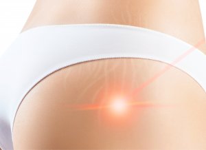 stretch mark laser treatments