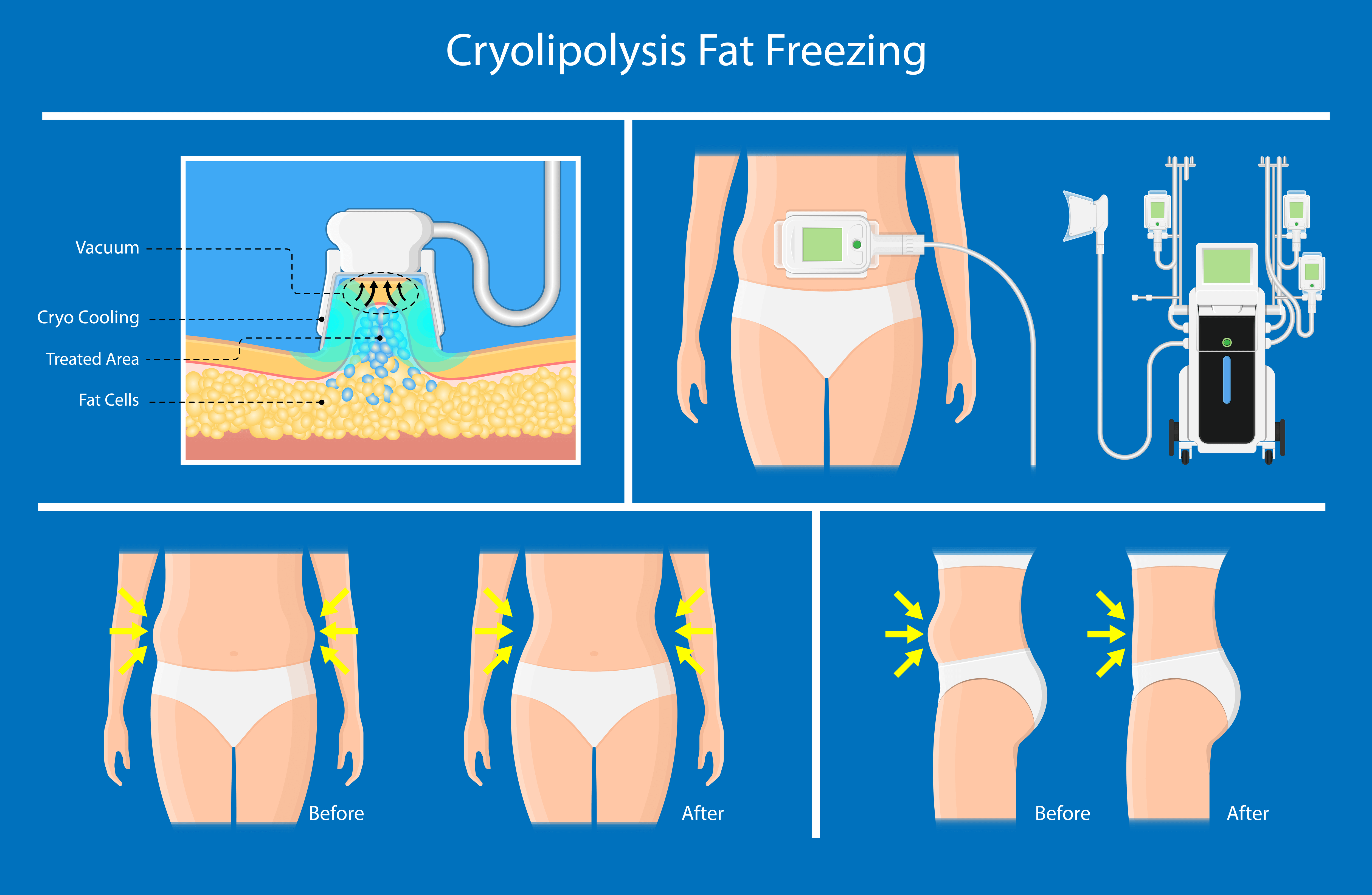 coolsculpting body contouring