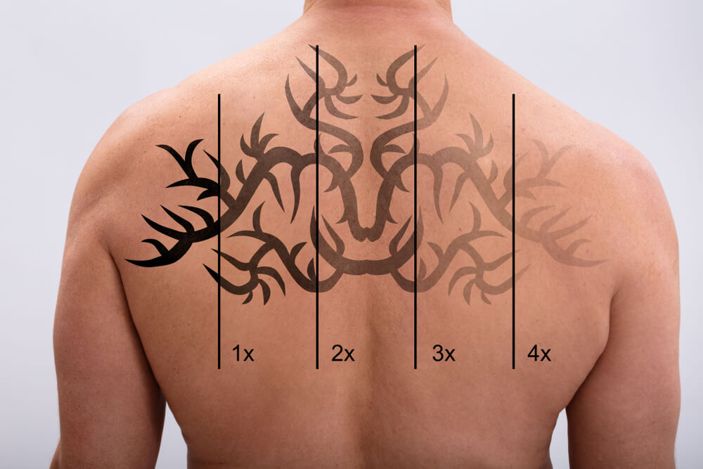 Non-Laser Tattoo Removal Online Training | UNDO Removal