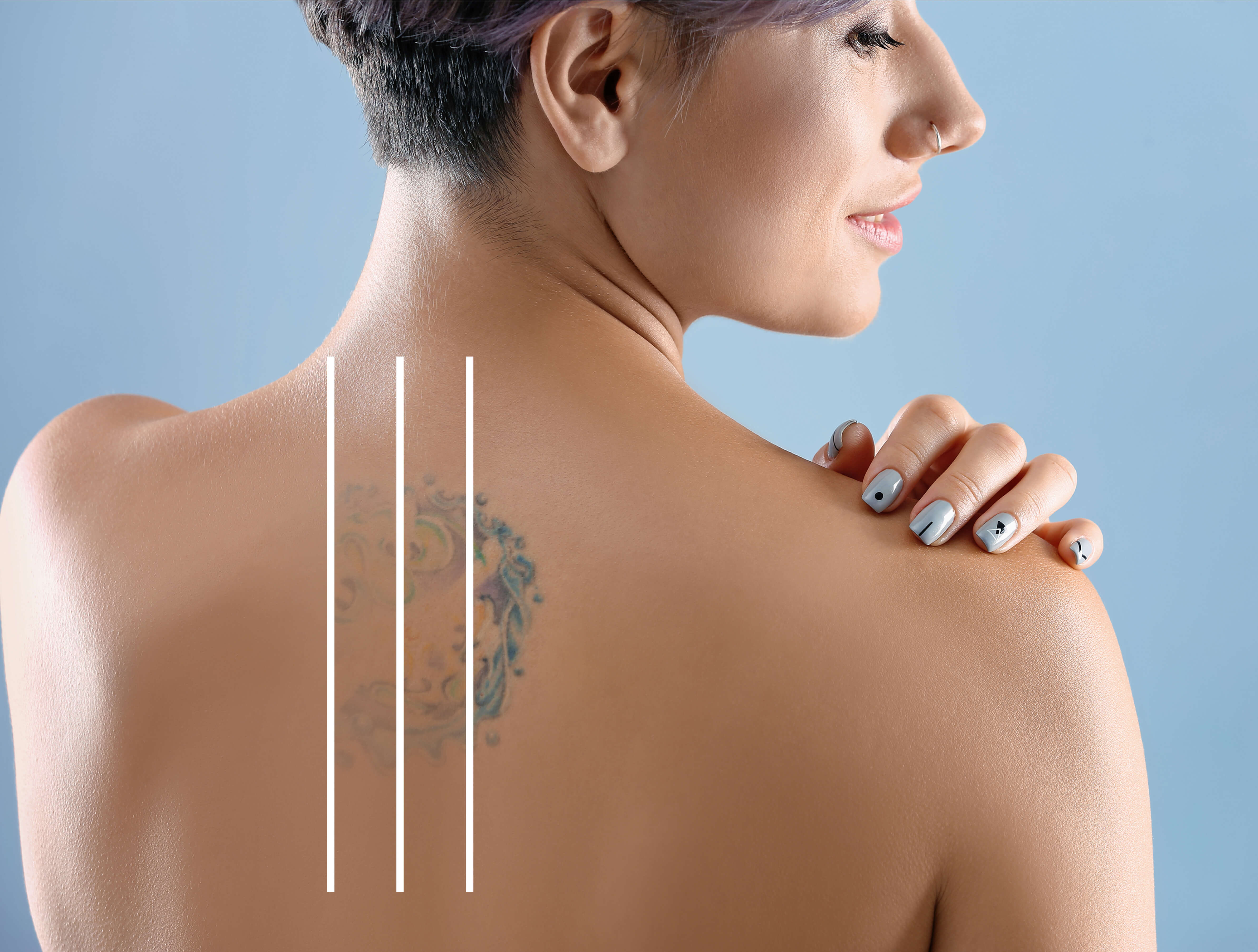 PicoWay Tattoo Removal in Vienna VA  Laser Tattoo Removal