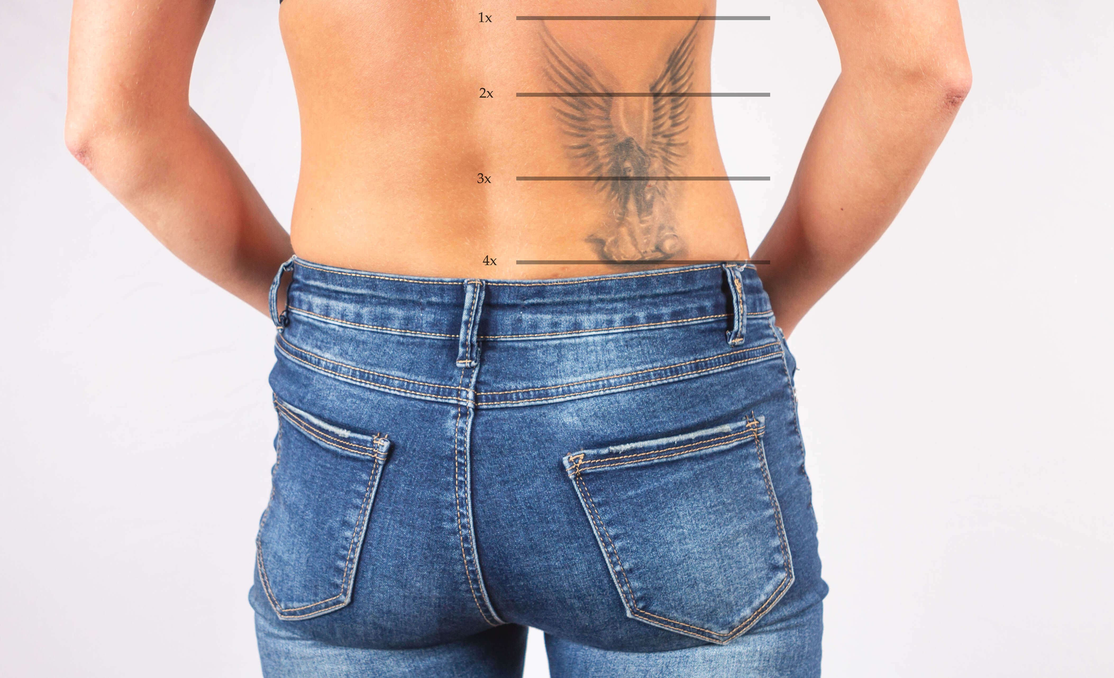 Laser Tattoo Removal in Boston MA  Providence RI  Skinsational