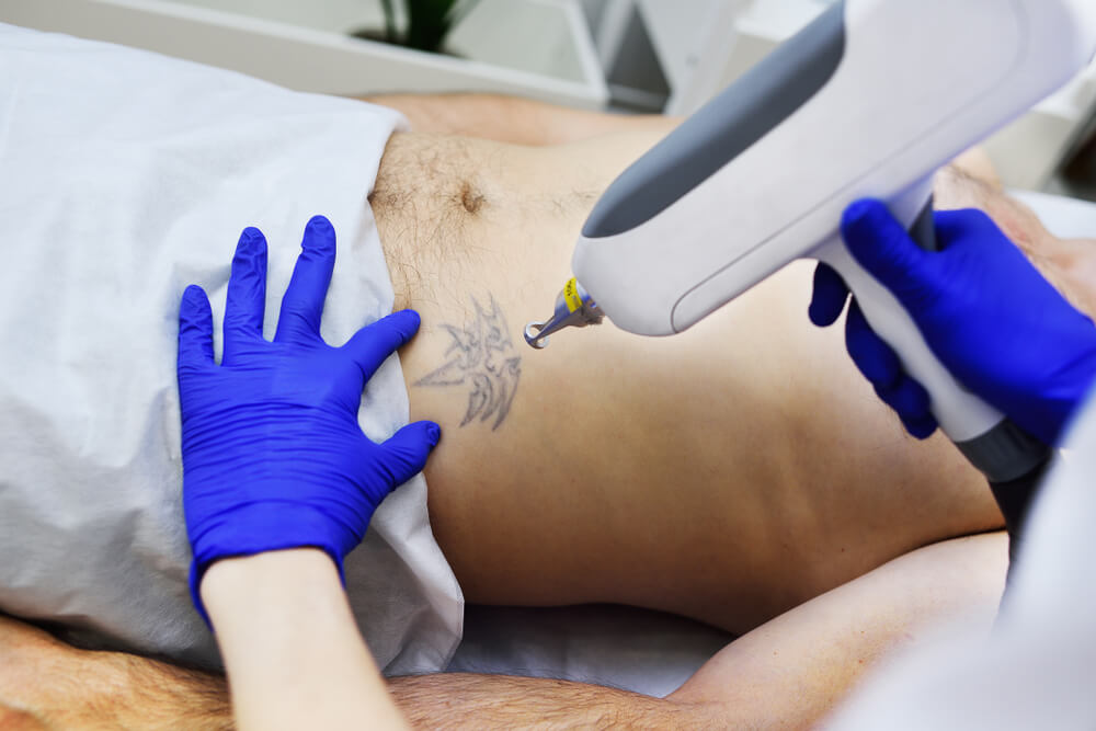 TATTOO REMOVAL – Professional Laser Training