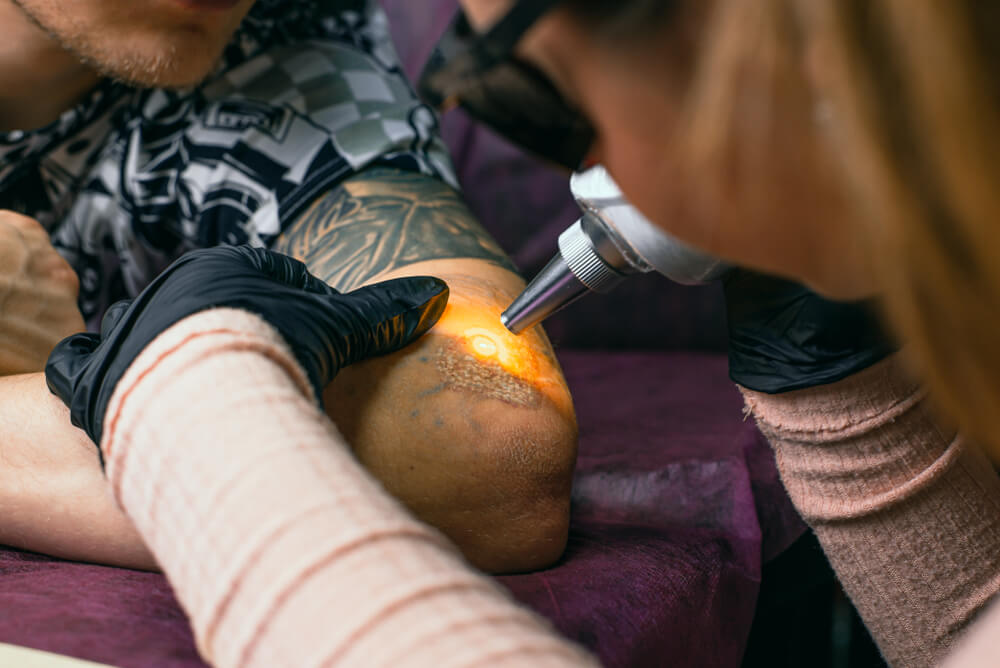 Non laser tattoo removal training  What the difference between laser and  non laser tattoo removal  OM SPA Microblading Academy Chicago   Microblading Training Chicago