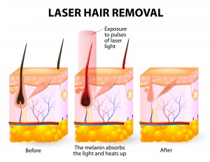 Laser Hair Removal Training