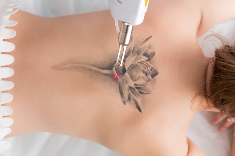 The Laser Tattoo Removal Business  Everything you need to know